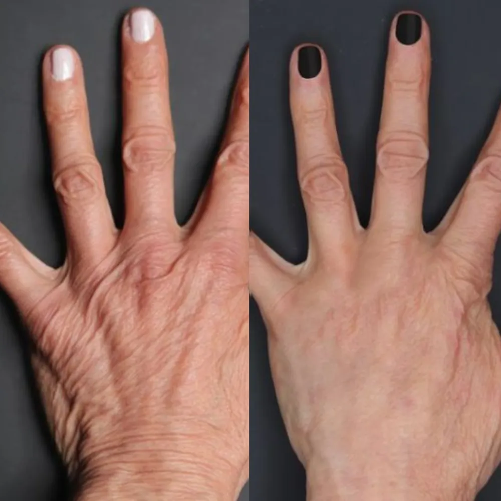 Stiff Hands before and after
